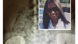 A Baltimore mother survives near death experience after IUD breaks into pieces
