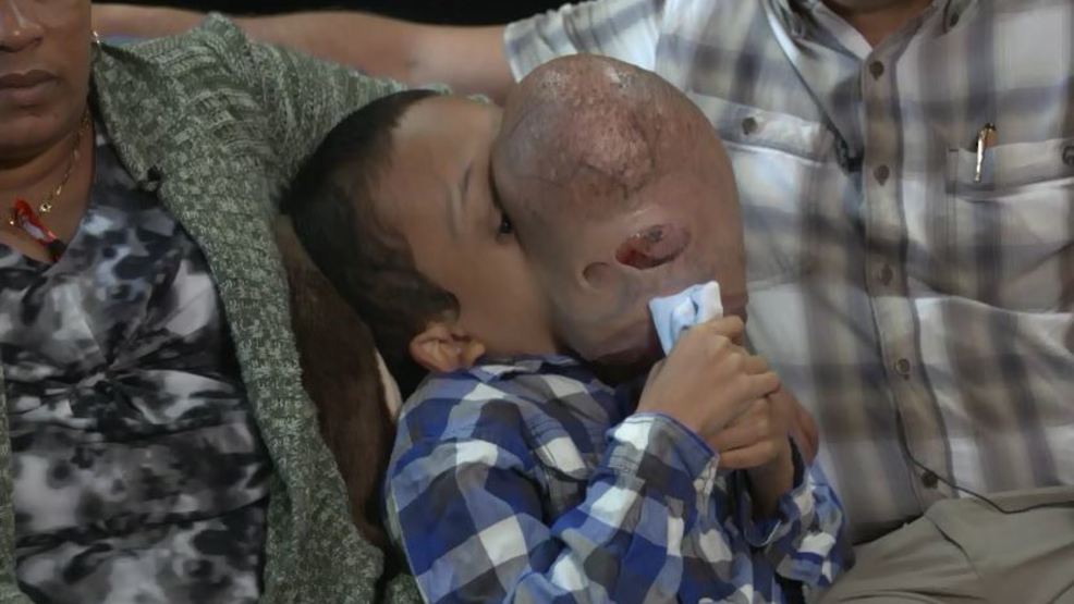 Cuban Boy Dies After Surgery To Remove 10 Pound Face Tumor Wsyx 8012