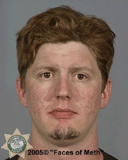 The Top 10 Worst Meth Transformations Addiction Center